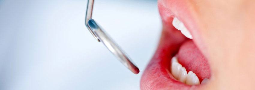 A dentist patient opening their mouth for a mirror